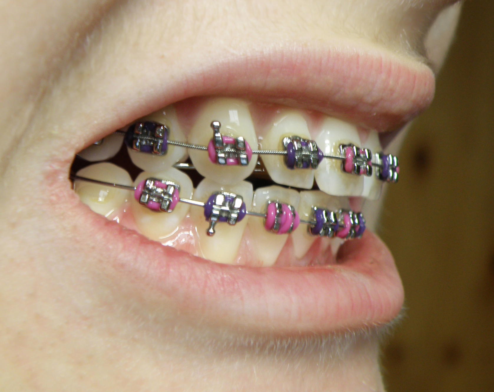 Close-up of orthodontic brackets and archwire fitted to a patient’s teeth